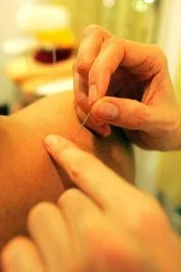 acupuncture_1